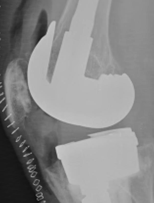 Revision TKR Posterior Femoral Augments
